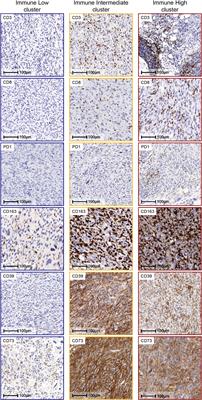 The immune landscape of undifferentiated pleomorphic sarcoma